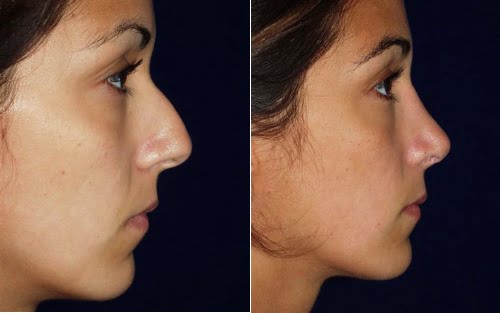 Rhinoplasty Portland - Nose Job Surgery Portland Oregon