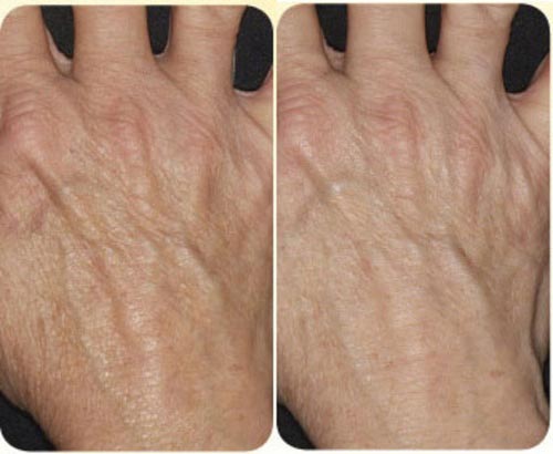 Before and after Thermage for the hands