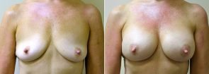 Breast Augmentation