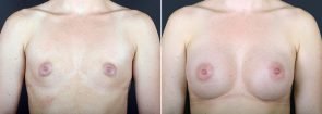 Breast Augmentation