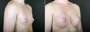 breast-augmentation-2351b-sobel