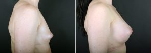 breast-augmentation-2351c-sobel