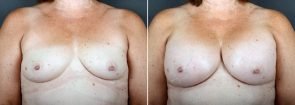 Breast Augmentation