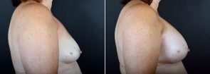 breast-augmentation-2362c-sobel