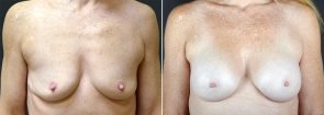 Breast Augmentation