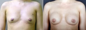 Breast Augmentation