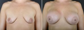 Breast Augmentation