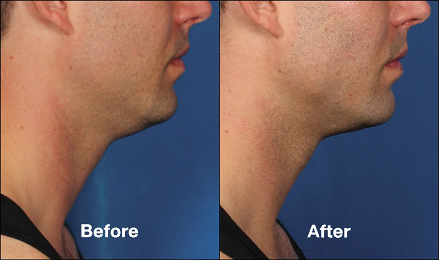 Before & after Kybella injections. Photos courtesy Allergan, inc.*