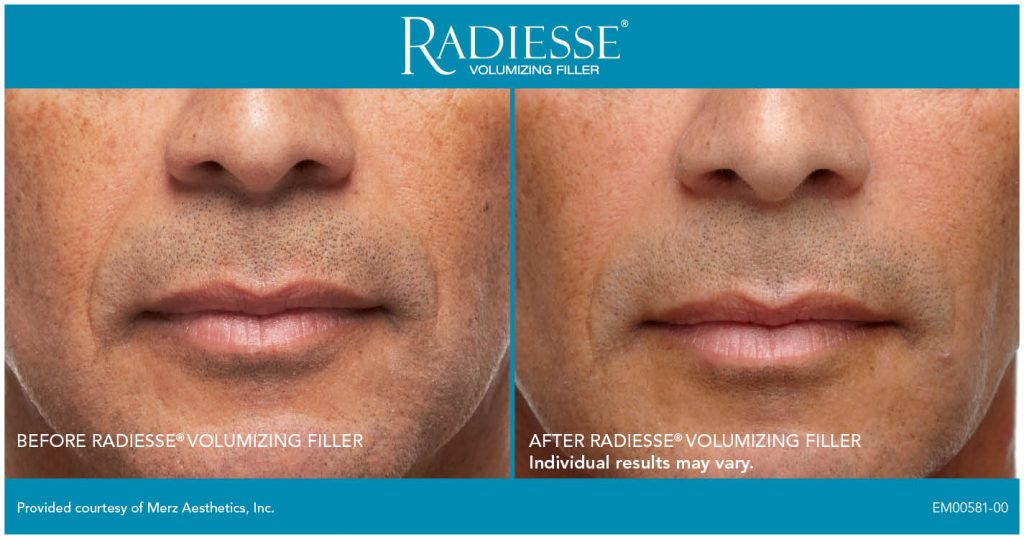 Radiesse before and after