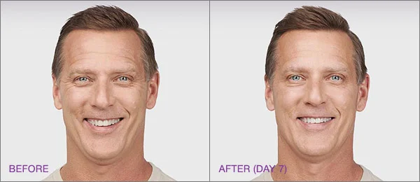 Male patient before and after botox