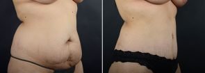 abdominoplasty-liposuction-12064b-sobel