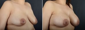 breast-augmentation-12064b-sobel