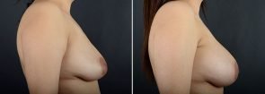 breast-augmentation-12064c-sobel