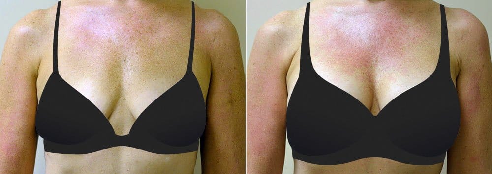 Before and after breast augmentation surgery with Dr. Alex Sobel in Seattle