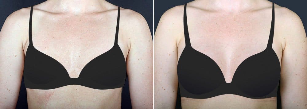 Before and after breast augmentation surgery with Dr. Alex Sobel in Seattle