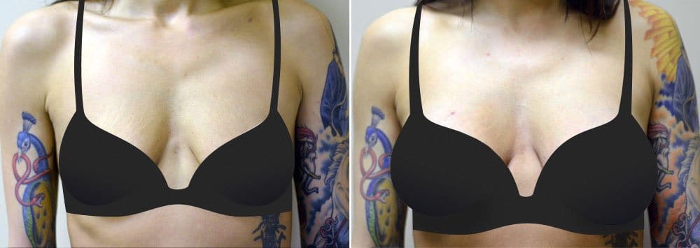 Before and after breast augmentation surgery with Dr. Alex Sobel in Seattle