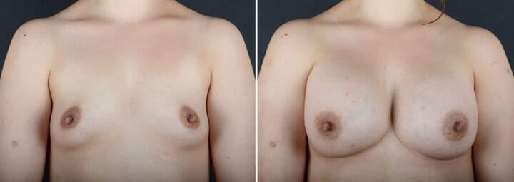 breast-augmentation-8514-3120a