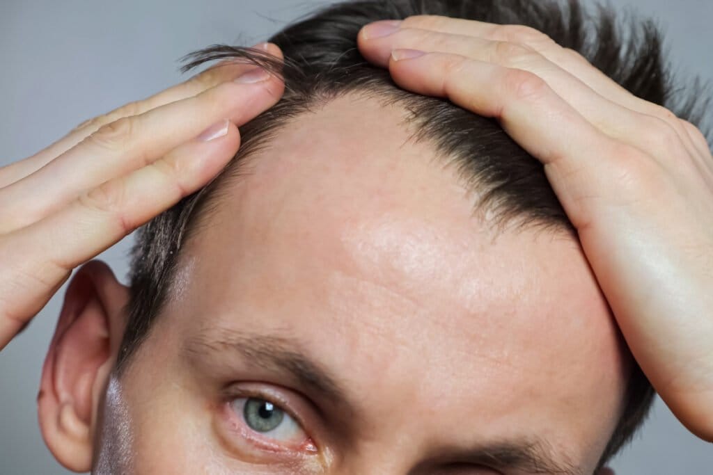 Close up of man pushing up hair to reveal a receding hairline