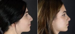 rhinoplasty-4134-9458c