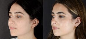 Rhinoplasty