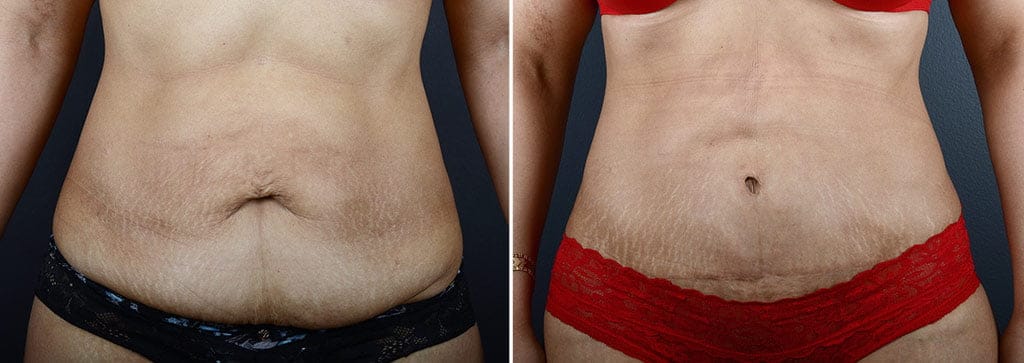 Antes y después de la abdominoplastia y la liposucción con el Dr. Sobel en Seattle