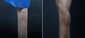 calf-augmentation-21883c-left-sobel