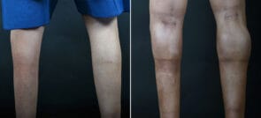 Calf Augmentation