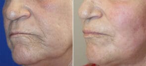 Laser Resurfacing