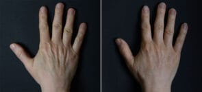 hand-rejuvenation-21822-left-sobel