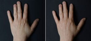 Hand Rejuvenation